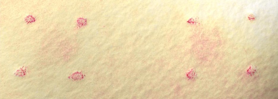 자외선 손상 진정 인체적용시험 — 2주 사용 후, 홍반이 옅어짐 (대상자 B)